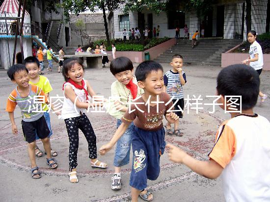 濕疹(濕疹長什么樣子圖片)