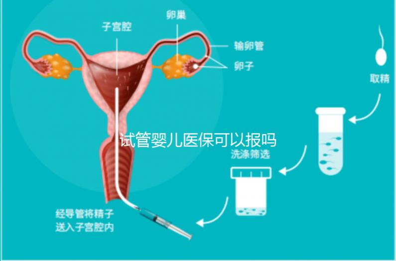 試管嬰兒醫(yī)?？梢詧?bào)嗎